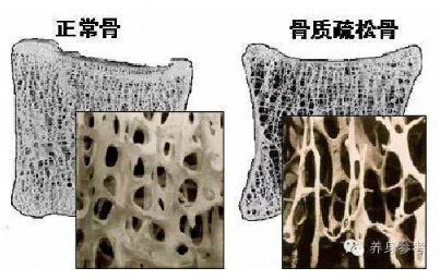 国产骨密度品牌你的骨头真的不能再等了 如何测量骨密度?